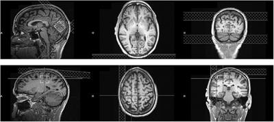 Visual cortical γ−aminobutyric acid and perceptual suppression in amblyopia